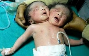 Bébé à deux têtes