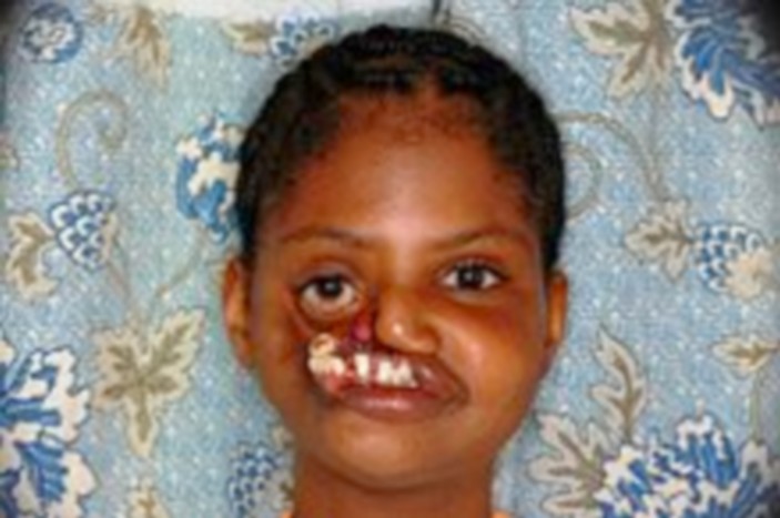 Noma,malédiction ou maladie de la&nbsp;misère?